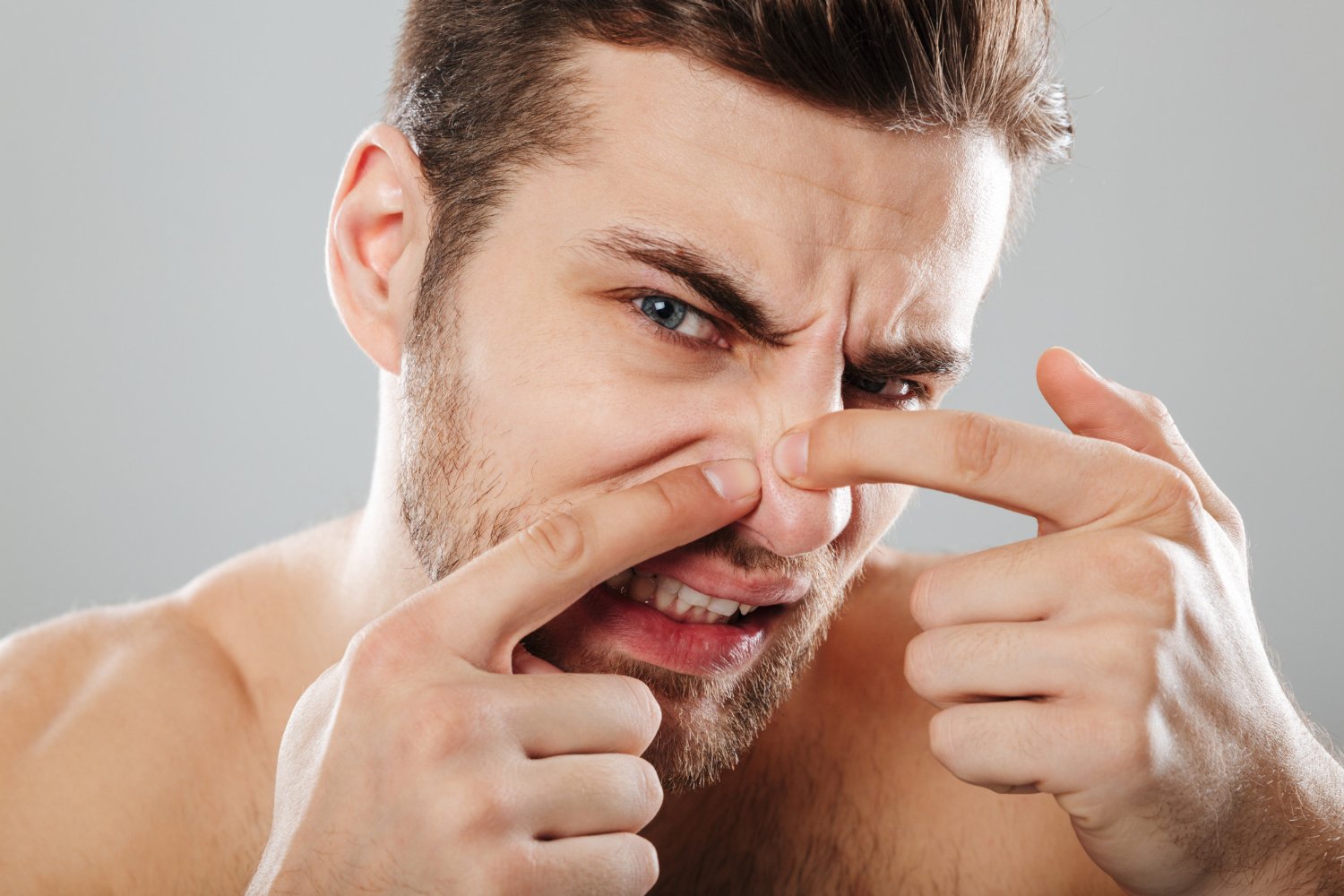 Blackheads removal tips: Your Ultimate Guide to Clear, Radiant Skin
